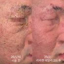 이지에프올로지의원 | 중증 아토피 치료 사례 3회차 20일의 호전 과정