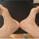 삼부한의원 | 좌측 발목 인대파열 치료후기-3