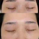스테이 무아 | 인천 눈썹문신제거 붉은색 잔흔 제거 후기, 스테이무아