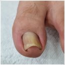 권선프라자 앞 | 수원 권선구 내성발톱 만족스런 찐 후기 레푸스 호매실점