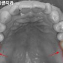 &#34;발치 후 비어있는 치아, 치료해야 되는 이유는?&#34; 우리바른 치과 임플란트 수술 후기