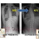 척추측만증 척추측만증 원인 척추측만증 적합한 운동 하면 안되는 운동 이미지