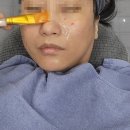 글로우미 | 의정부피부과 포커싱 마이크로웨이브 미글로우 리프팅 턱선관리 솔직 후기