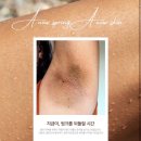 뷰-라인 | 색소침착 고민 끝 뷰티뷰헤어라인 대전 멜라닌케어 후기