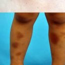 소아 성인 자반증 증상 및 치료 (다리, 피부 붉은반점 혈관염) 이미지