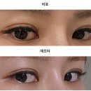 플러스아이미코병원 | 마곡피부과 ,강서피부과 피코플러스 아이라인 문신제거 후기