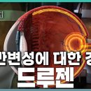 진행 빠른 황반변성 조기 발견의 열쇠, 드루젠 | KBS 240228 방송 이미지