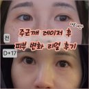 포인트의원 | 강남 주근깨 레이저 내돈내산 후기: 17일 만에 지우개로 지운 듯한 리얼 변화 (feat. 벨포인트의원)