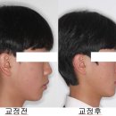 고운맘의원 | 안양교정치과 서울고운미소치과 교정 후기
