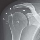 Re: 회전근개 석회화(극상근, 견봉하점액낭, 극하근, 견갑하근) 2018년 이미지