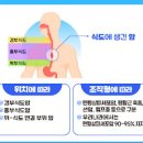 식도암 초기증상 원인 치료 이미지