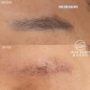 [공지] 옛날 푸른 흑백 눈썹 잔흔 제거 송파 가든파이브 줄리아뷰티 후기
