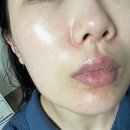 [리뷰] 흉터 재생크림 '레디우스' 알엑스더마 극건성 피부 후기