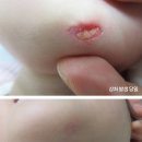 아무러스성형외과의원 | 대구 얼굴 상처치료 아무러스 성형외과 후기 [5살, 턱 찢어짐 기록]