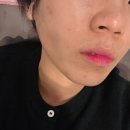 안성맞춤한의원 | 해율한의원 율각테라피 홍대 여드름 흉터 관리