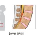 척추협착증 이미지