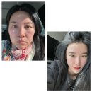 압구정미라클의원 우정호원장님퀼실리프팅 후기