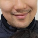 맥스 | 광주 남자제모 추천 젠틀맥스프로 후기