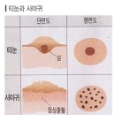 발바닥 발가락 티눈, 굳은살 예방및 통증없는 관리방법 이미지