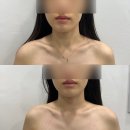 청주웨딩관리 / 웨촬 전 윤곽관리 후기 “청주 후광미인”