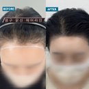 양산헤어라인 최다작업 다미라인