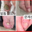 내성발톱발톱무좀관리김수정뷰티 이미지
