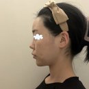 태성형외과의원 | 신논현 성형외과 코성형 재수술 후 삶의 만족도 최고!