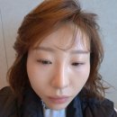 (주)엔도코코리아 | 대구 동성로피부과에서 코필러 대신 리쥬엘코 | 코끝 라인 달라진 솔직 후기 변화
