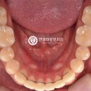 박상욱치과의원 | 선유도 치과 사랑니 발치 및 어금니 비발치 교정 치료 후기