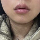 어린공주 성형외과의원 첫 입술필러 후기 (+2주, 2개월 지난후기)