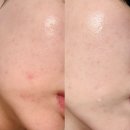 워시포커스 | 여드름흉터재생크림 리라클 베리어 포커스 재생크림 사용 후기