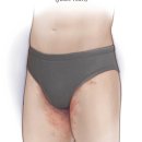 백선세탁 | 사타구니 백선 체부백선 피부 곰팡이균 원인 및 증상 관리 및 치료 방법 위생관리 및 보습 관리를 위한...