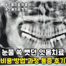 그레이스e치과의원 | 잇몸치료 비용부터 방법 치과 과정 통증까지 (마취 후기 &amp; 실비 꿀팁 정리)