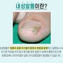 내성발톱 자가 / 병원 (엄지 발톱 염증 발가락 부음 통증) 이미지