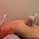 1519/ Getting acupuncture could help ease the pain. 이미지