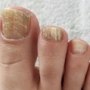 엄지약국 | 엄지 발톱무좀연고 로세릴네일라카 강화 사용법