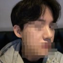 코코모이비인후과의원 | 남자 기능코 비염수술 무보형물 남자 코성형 후기 (수술후 ~ 일주일, 내돈내산)