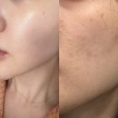 메이린 | 내 얼굴 폼 좋아짐. 시술 추천 스타워커토닝, 제네시스토닝 후기 ' 메이린의원 판교점' | 분당 피부과 추천