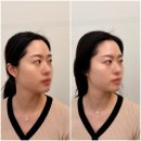 토탈코리아 | 대구피부관리 "제이라인코리아 토탈뷰티" 올리푸 리프팅 관리+볼륨 에어젯 후기