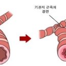 천식 ㅡ 기관지 알러지 이미지