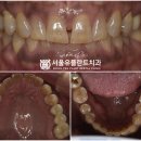 왕십리역 치과 - 1년 만에 부러진 브릿지 보철, 해결 방법은? 고난도 수면 임플란트 수술 후기