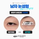 아이큐성형외과의원 네이버블로그
