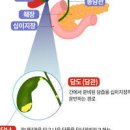 담낭이란 쓸개 역할 담낭암 원인 증상 치료 이미지