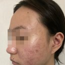 홍대인근 | 여드름한의원 후기 홍대입구&amp;신촌 인근 추천