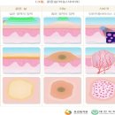 새이모퉁이 | 신진대사 이상/감염에 의한 이상 증상