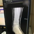 피오르의원 | 발목(비골) 골절 수술 및 재활 후기