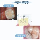 매일 칫솔질을 열심히 하는 데 왜 충치가 생기나요? 어린이 충치 잘 생기는 원인과 그 예방법