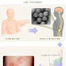 B02 대상포진 Zoster [herpes zoster] 이미지