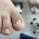 세븐일레븐 화성봉담주공점 | 화성 봉담발톱무좀 파고들고 아프다면 가봐야 할 발라발라네일 봉담점