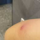 구올담치과병원 | 부평역 피지낭종 제거 잘하는 비엘클리성형외과